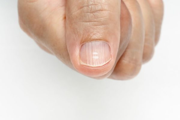 Борозды на ногтевой пластине