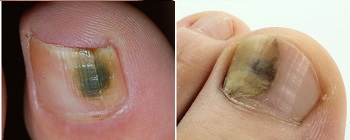 Темные пятна на ногтях при грибковой инфекции