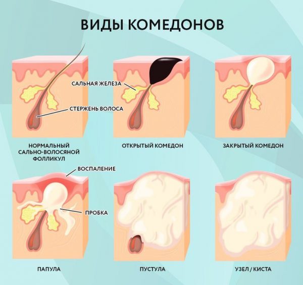 Виды комедонов