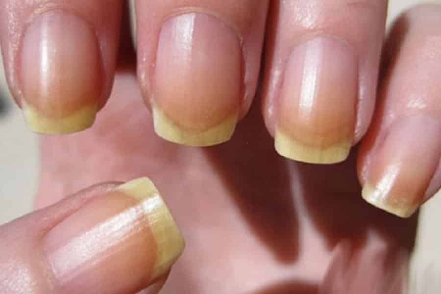 почему ногти желтеют