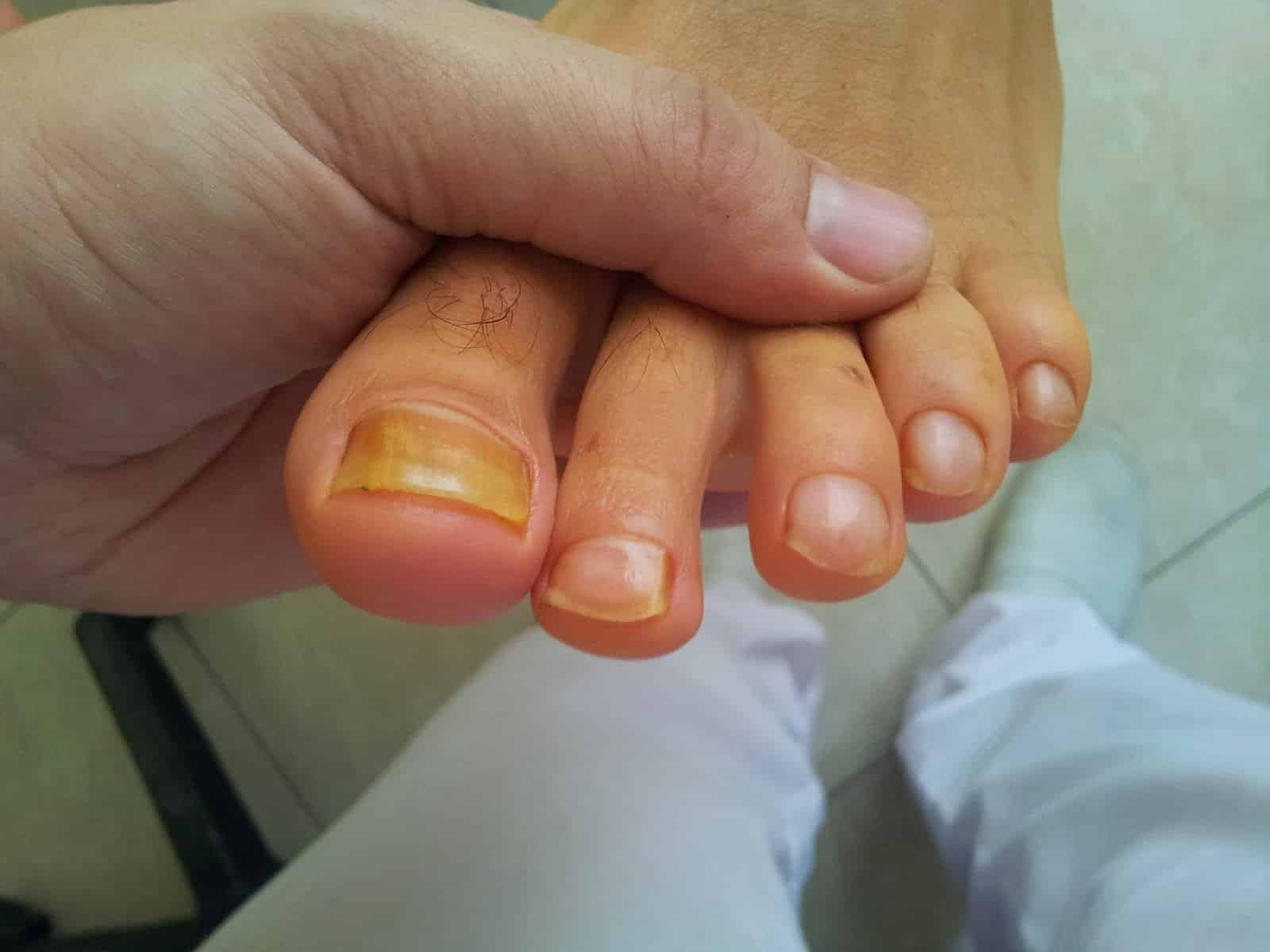 Ногти желтеют на ногах. Почему желтеют ногти на ногах и руках у женщин, мужчин, детей: причины. Как лечить желтые ногти на руках и ногах?