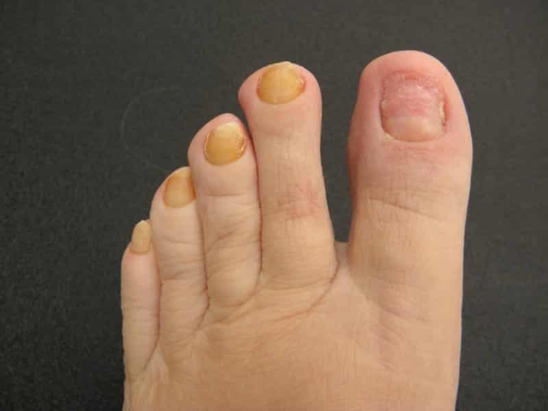желтые ногти на ногах