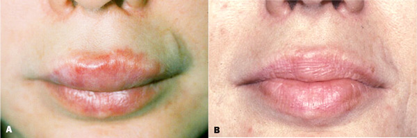 Возможные последствия увеличения губ гиалуроновой кислотой