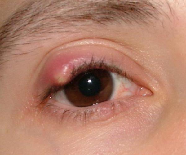заболевание глаза ячмень 