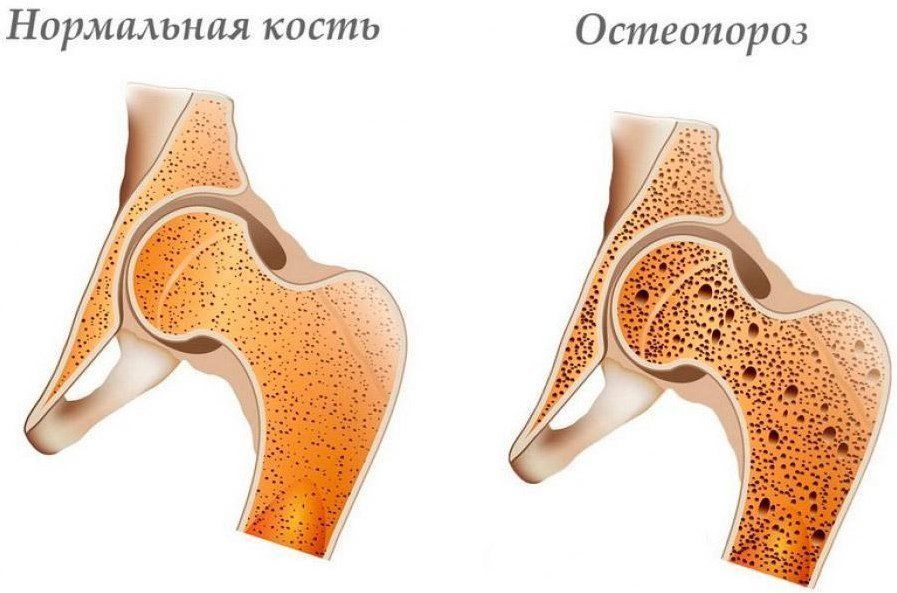 Нормальная кость и остеопороз