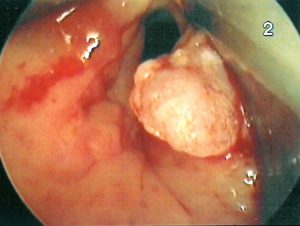 Новообразование в гортани