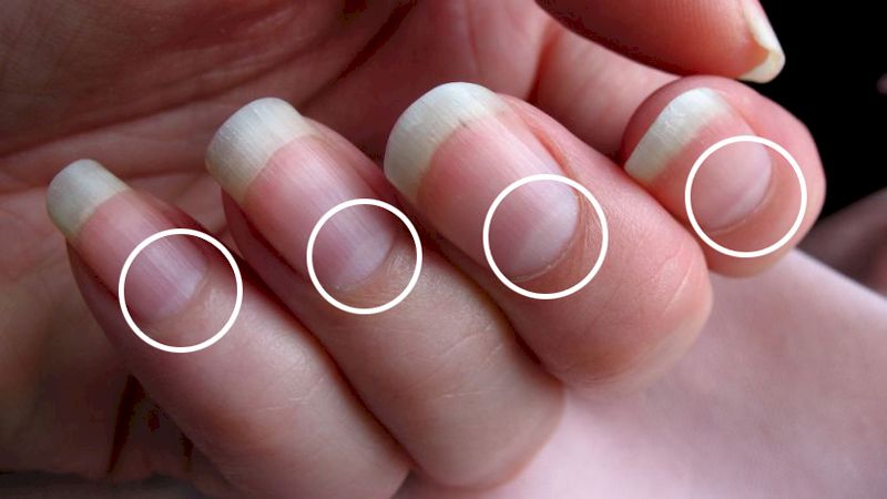 Диагностика по лунулам: о каких проблемах со здоровьем предупреждают ногтевые лунки
