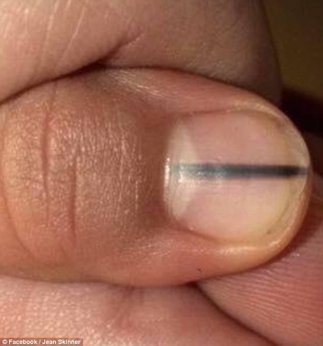 The client had dismissed the stripe as a blood blister or a sign of a calcium deficiency until the nail technician urged her to seek medical advise ¿ then she was diagnosed with skin cancer