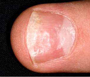 Pitted nails can be an indication of psoriasis or eczema