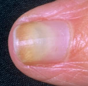 Discoloured nails can be caused by a yeast or fungal infection 