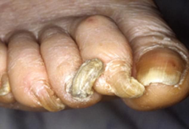 Ram¿s horns nails, also called onychogryphosis, is a condition characterised by a thickening and lengthening of the fingernails or toenails