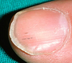 Streaks are usually just from splinters but if several nails are infected seek medical help