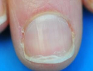 Split nails can be caused by ageing, but may also be caused by infections or an underactive or overactive thyroid