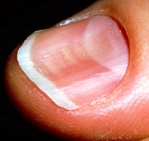 Spoon-shaped nails can be iron deficiency