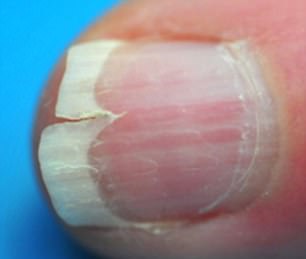 Ridging on nails is usually harmless