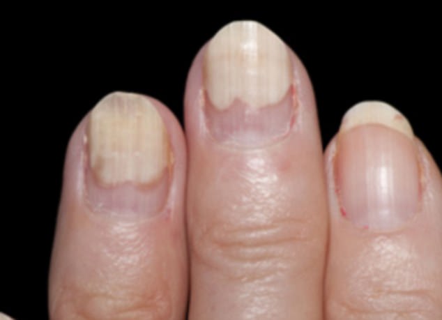 When the tip of the nail lifts it can be psoriasis or a fungal disease
