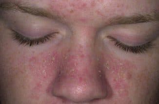 Как избавиться от шелушения кожи на лице