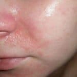 Крем от шелушения кожи на лице