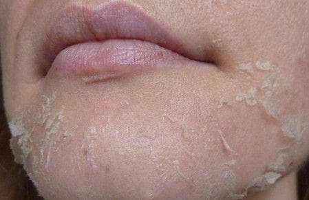 Шелушение кожи на лице