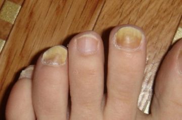 грибок ногтей