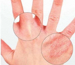 Почему шелушится кожа на пальцах рук