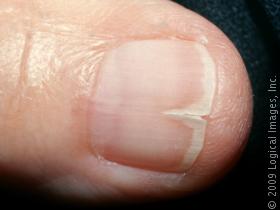 split fingernails 