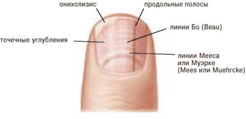 Полосы и вмятины на ногтях. Почему появляются ямки и дырочки на ногтях, о чем они говорят