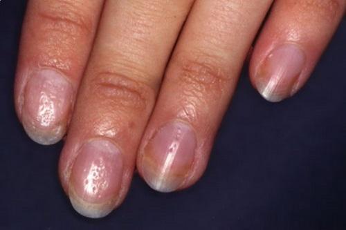 Дырки в ногтях причины. Причины и лечение наперстковидной (точечной) истыканности ногтей