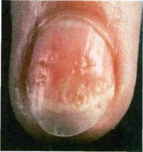 Дырки в ногтях причины. Причины и лечение наперстковидной (точечной) истыканности ногтей