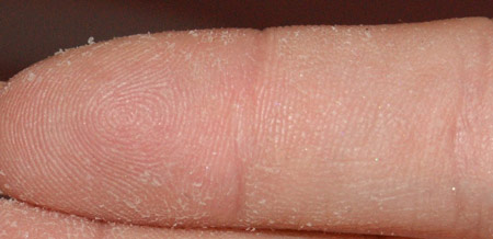 Проблема огрубения и шелушения кожи на пальцах рук