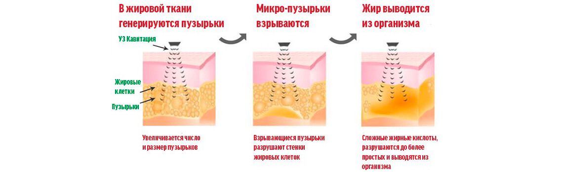 Проведение процедуры кавитации