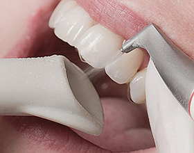 Профессиональная чистка зубов — плюсы и минусы процедуры
