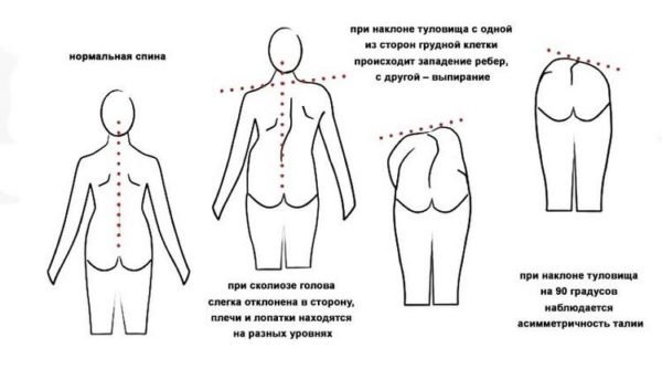 Признаки сколиоза 