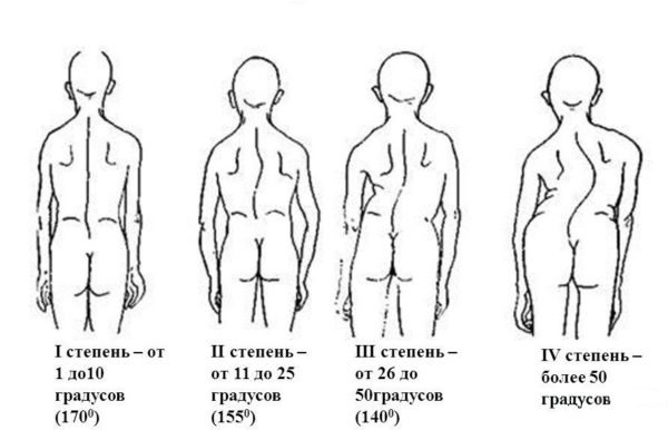 Степени сколиоза