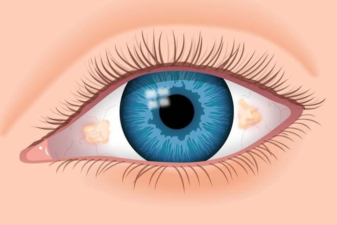 Типы глаз - Приподнятые уголки (азиатский)