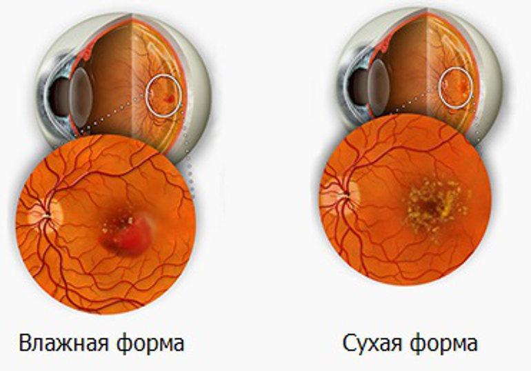 Макулярная дегенерация