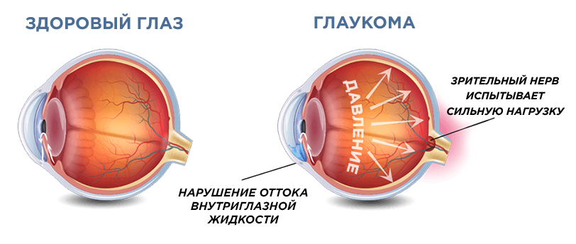 Схема здорового глаза и глаукомы