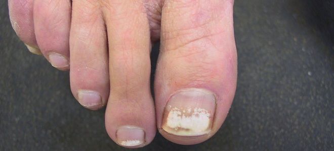 Белые пятна на ногтях ног причины