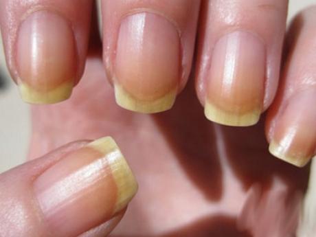 7 способов избавиться от желтизны ногтей и отбелить их