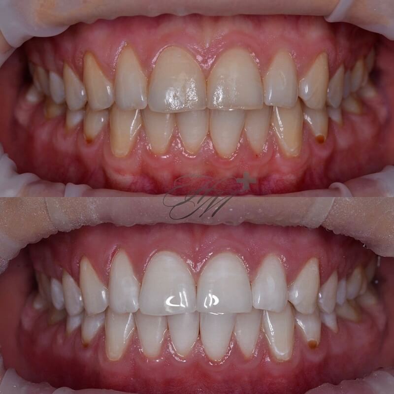 Отбеливание зубов, до и после
