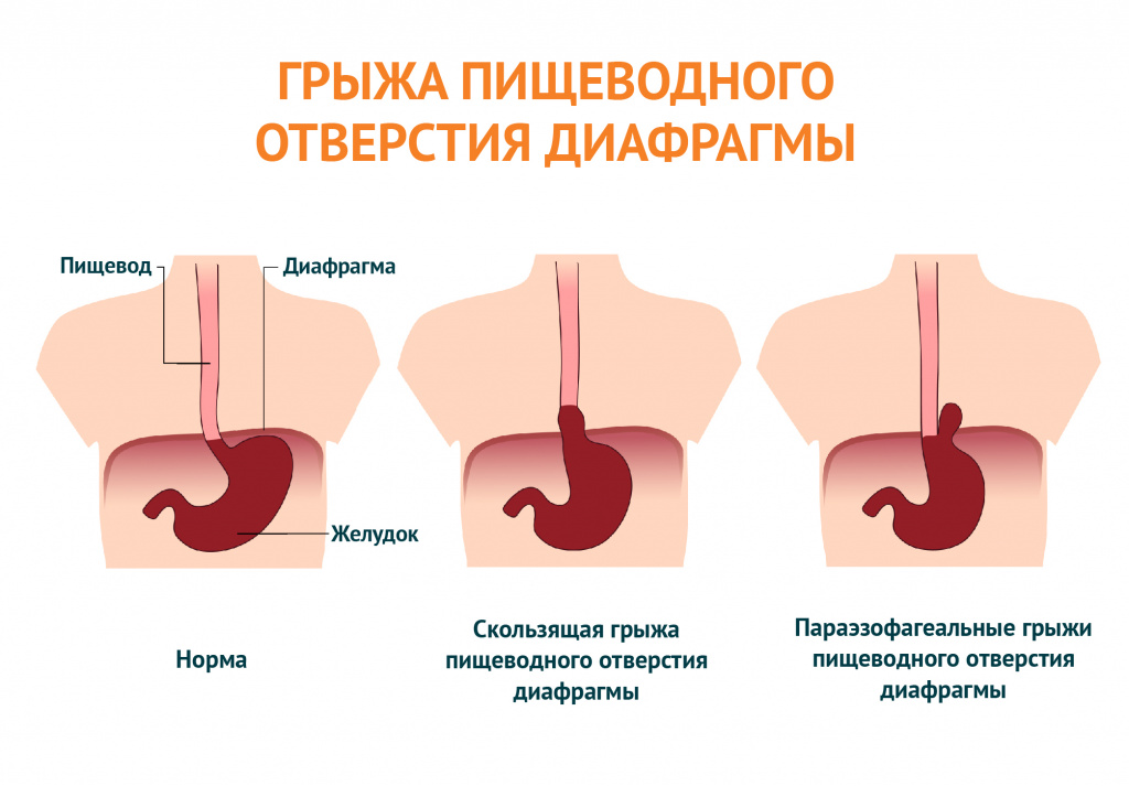 грыж пищеводного отверстия диафрагмы.jpg