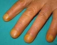 Синдром желтого ногтя 