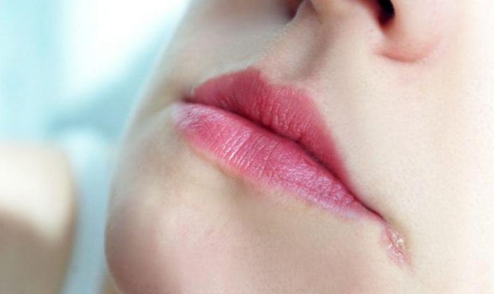 почему трескаются уголки губ